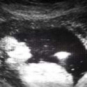 sonogram - baby